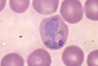 Beeld: Wikimedia, malaria